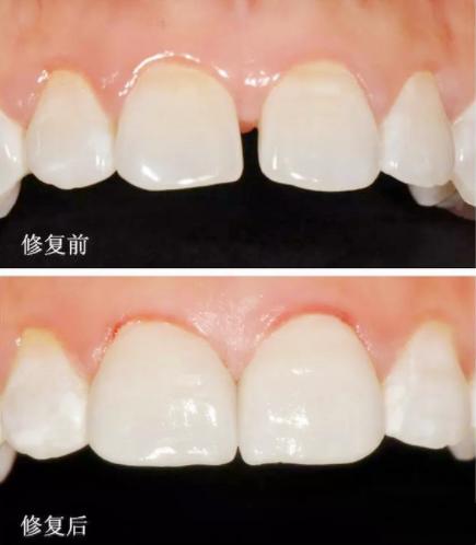 牙齿超薄贴面怎么样？多少钱一颗？也许这个是你更关心的
